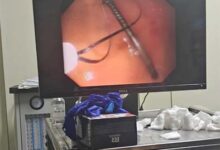 एंडोस्कोपी से पेट से कील निकाली -छिंदवाड़ा के क्लैरिस हॉस्पिटल में एंडोस्कोपी से बच्चे के पेट से कील निकालते डॉक्टर