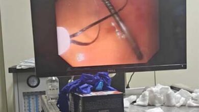 एंडोस्कोपी से पेट से कील निकाली -छिंदवाड़ा के क्लैरिस हॉस्पिटल में एंडोस्कोपी से बच्चे के पेट से कील निकालते डॉक्टर