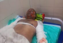 सिवनी में नरवाई की आग हादसे के बाद शिक्षक परिवार की स्थिति, घायल दंपति को अस्पताल ले जाते लोग
